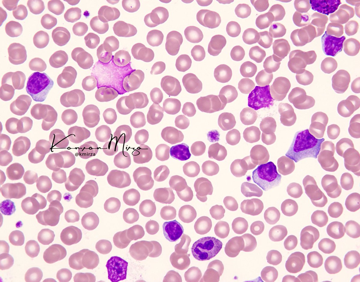 #hemepath #bloodsmear #pathology #labmedicine #DailyHemepath #ASCP100 #ASCP2022 An older patient with leukocytosis. What things can you deduce about the patient's condition(s) from this smear? Learn more (including explanation) here: kikoxp.com/posts/14800