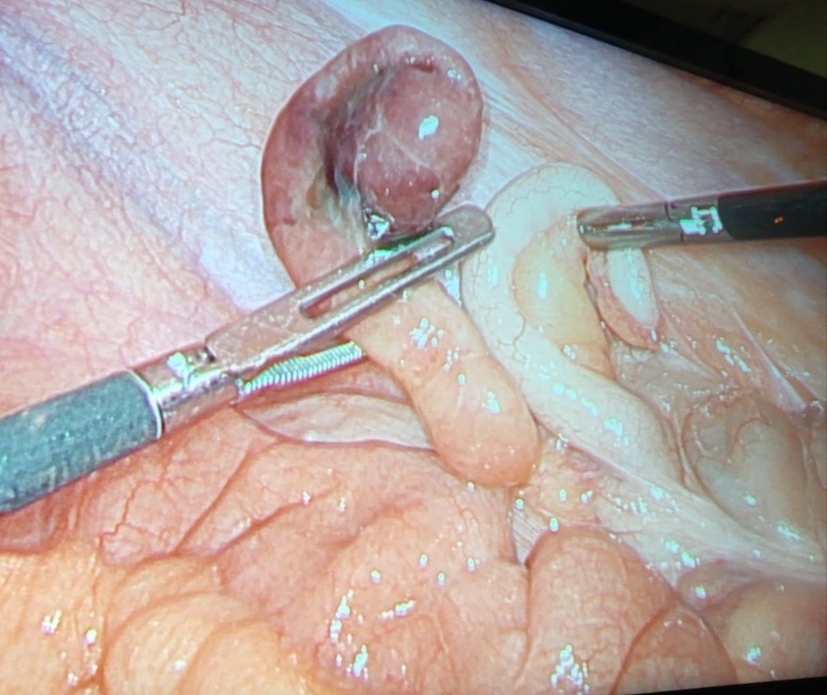 Ernest Bombuy (@ebombuy) on Twitter photo Who is Who in #emegencysurgery ? <a href="/CSdMaresme/">Consorci Sanitari del Maresme</a> <a href="/Dlopezca1/">Dlopezca</a> <a href="/StcuaeC/">AECUrg</a> <a href="/SCatCir/">Societat Catalana de Cirurgia</a> Who is Who in #emegencysurgery ? <a href="/CSdMaresme/">Consorci Sanitari del Maresme</a> <a href="/Dlopezca1/">Dlopezca</a> <a href="/StcuaeC/">AECUrg</a> <a href="/SCatCir/">Societat Catalana de Cirurgia</a>