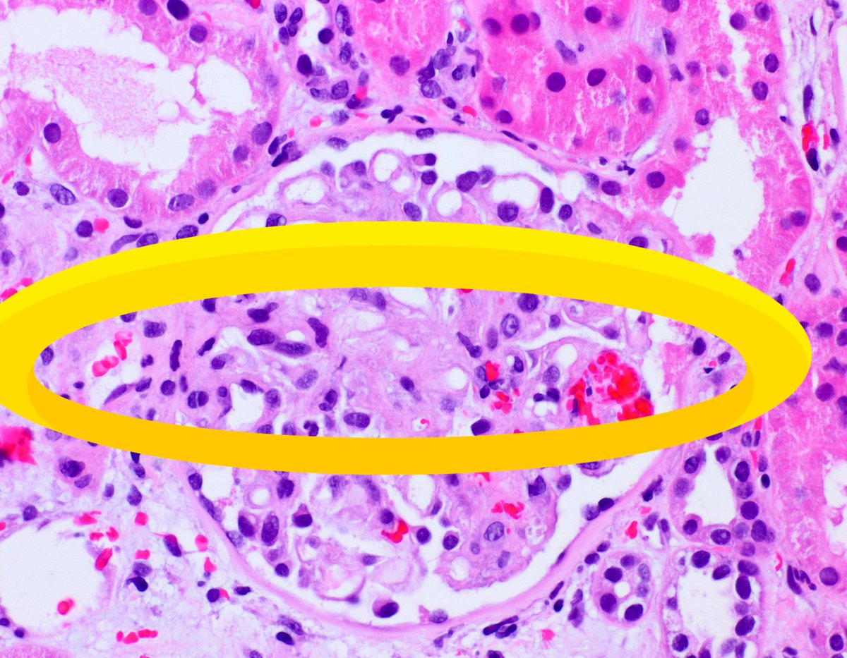 AvelRomanNeph's tweet photo. @arkanalabs #FSGE secondary? Here I can see that and #CMV infection ? https://t.co/jPxinBBwdj