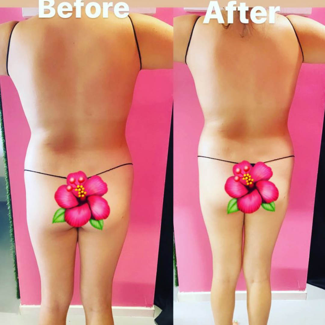 SnatchingBLA's tweet photo. Give SnatchingBodiesLA a visit today to find out how affordable our Butt Lift services are in the Hermosa Beach area! #ButtLift https://t.co/zY59mLMgyR https://t.co/W4awOnYxuj