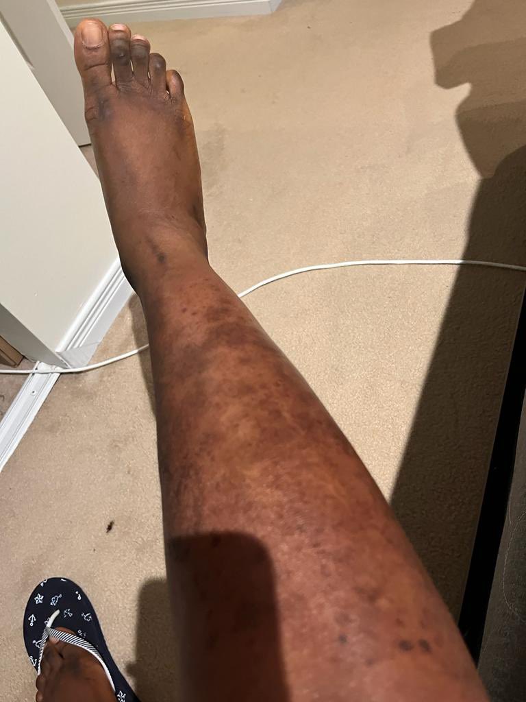 laterma2's tweet image. Les’effets secondaires de la depigmentation @DrManaouda #stopdepigmentation