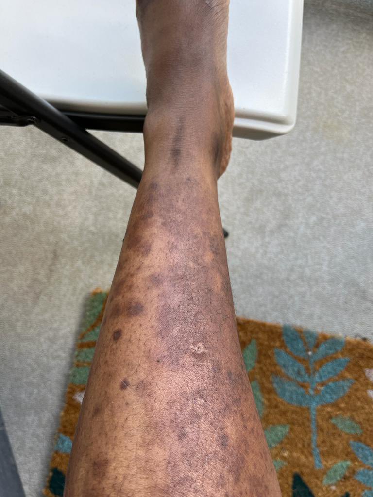 laterma2's tweet image. Les’effets secondaires de la depigmentation @DrManaouda #stopdepigmentation