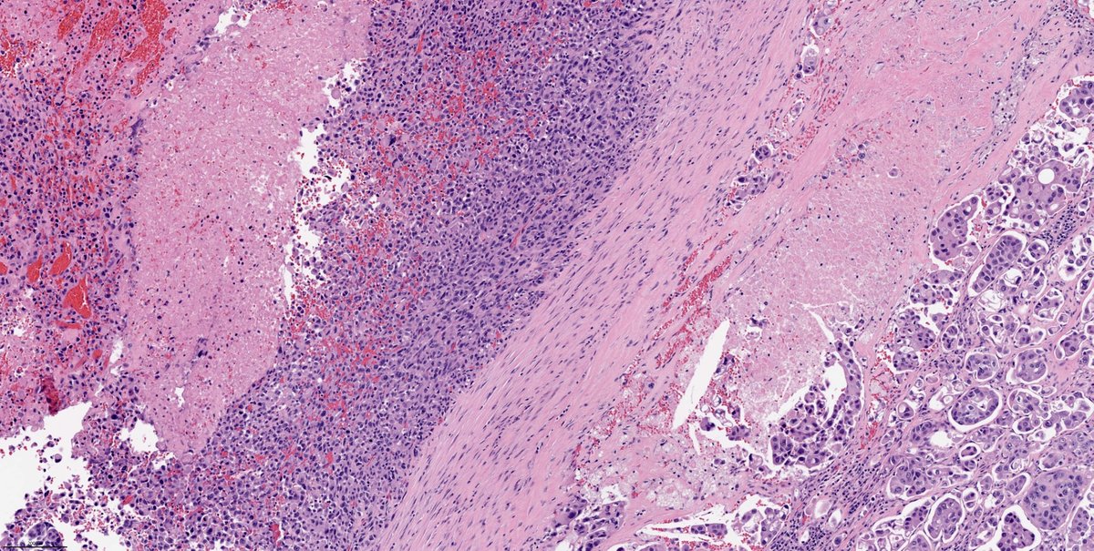 Salivary duct carcinoma, micropapillary and sarcomatoid variant #ENTpath