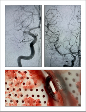 PenNeuro's tweet image. US HCPs: Dr. Matt Fiesta uses #RED72 for this case out of Texas Health Harris Methodist. #REDglideDifference Rx only. For risk info: bit.ly/37YcYIU Clinical results may vary.