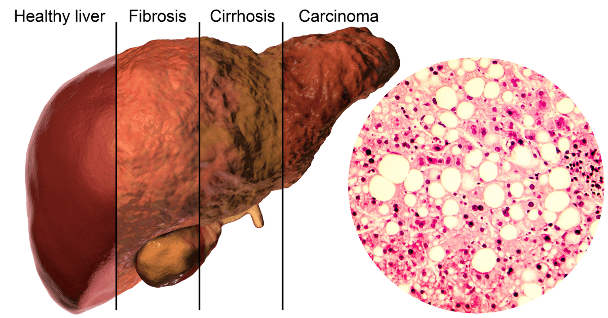 UMassDiabetes's tweet photo. Newly published #research from @CzechLab in @jbiolchem studied fat production in the liver from carbohydrates by disrupting an enzyme that helps to convert blood glucose into fat. https://t.co/B4WZKB8YwA
#T2D @UMassChan @ProgMolMed https://t.co/aBMVz2C8XL