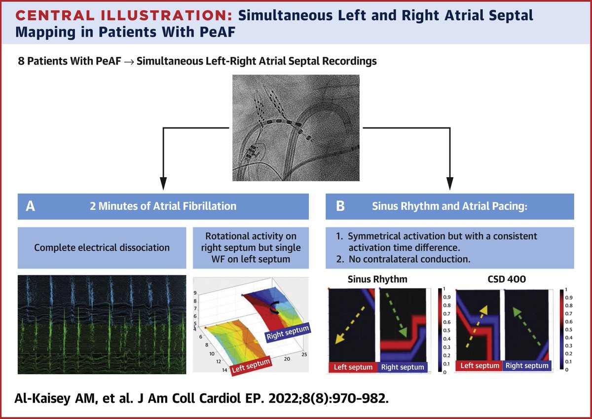 JACCJournals's tweet photo. Drs. @AhmedAlkaisey, @JonKalmanEP, &amp; team elucidate the patterns &amp; degree of electrical dissociation between the LA/RA septal surfaces via simultaneous high-density multipolar mapping in #PersistentAFib pts. Is there conduction? https://t.co/S5XUVR3Piw

#JACCCEP #EPeeps #AFib https://t.co/tQPMF8Fb79