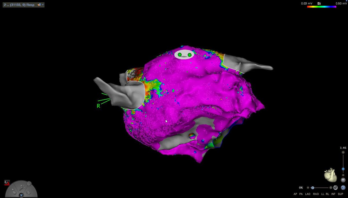 Rui ProvidĂȘncia (@rui_providencia) on Twitter photo Atrial tachycardia post Convergent-hybrid AF ablation procedure - #EPeeps more to follow!  Baseline voltage map #catheterablation #atrialfibrillation #af Part #2 Atrial tachycardia post Convergent-hybrid AF ablation procedure - #EPeeps more to follow!  Baseline voltage map #catheterablation #atrialfibrillation #af Part #2