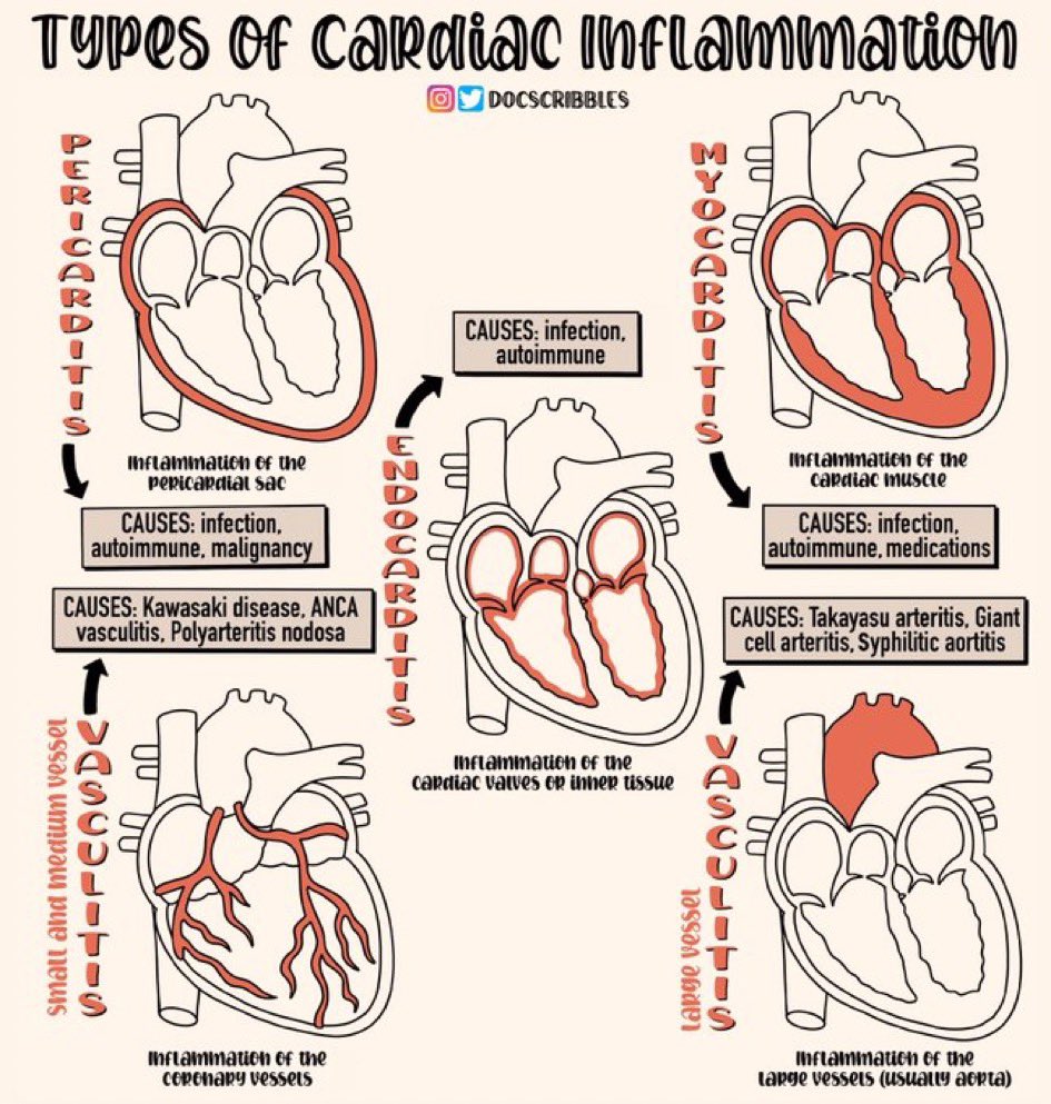 Paul_Wischmeyer's tweet photo. ❤️ Cardiac inflammation types
#MedEd #MedTwitter #FOAMed
More excellent work from @DocScribbles https://t.co/Vx0YNV64Qy