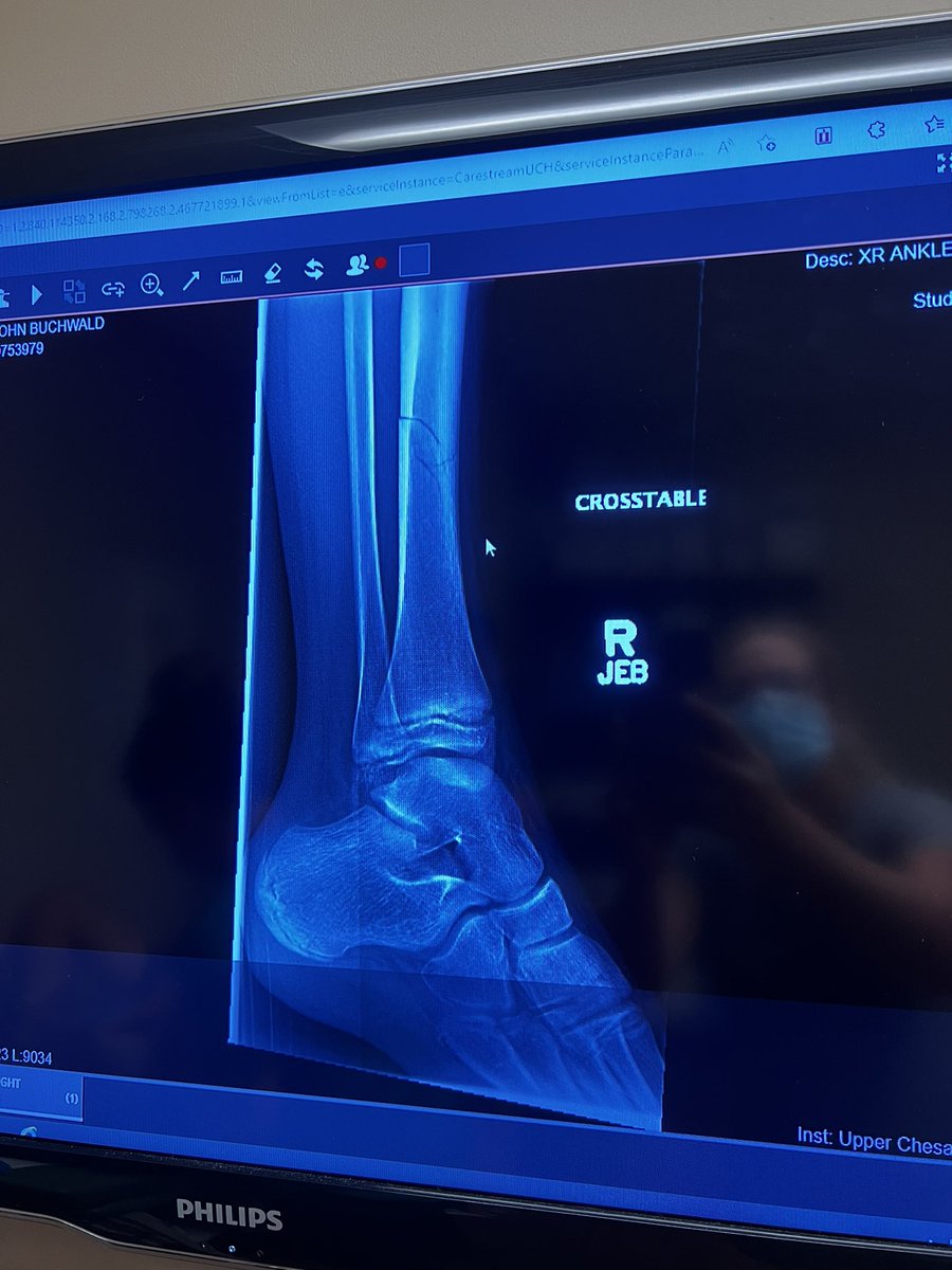 BuchwaldHelene's tweet photo. Thank you #adidas for making kick ass shin guards!  Had it not been for them, my son would be needing surgery to reset his tibia, which was broken in 3 places on Saturday during a soccer tournament. Highly recommend #adidas shin guards! https://t.co/RwiufwPes1