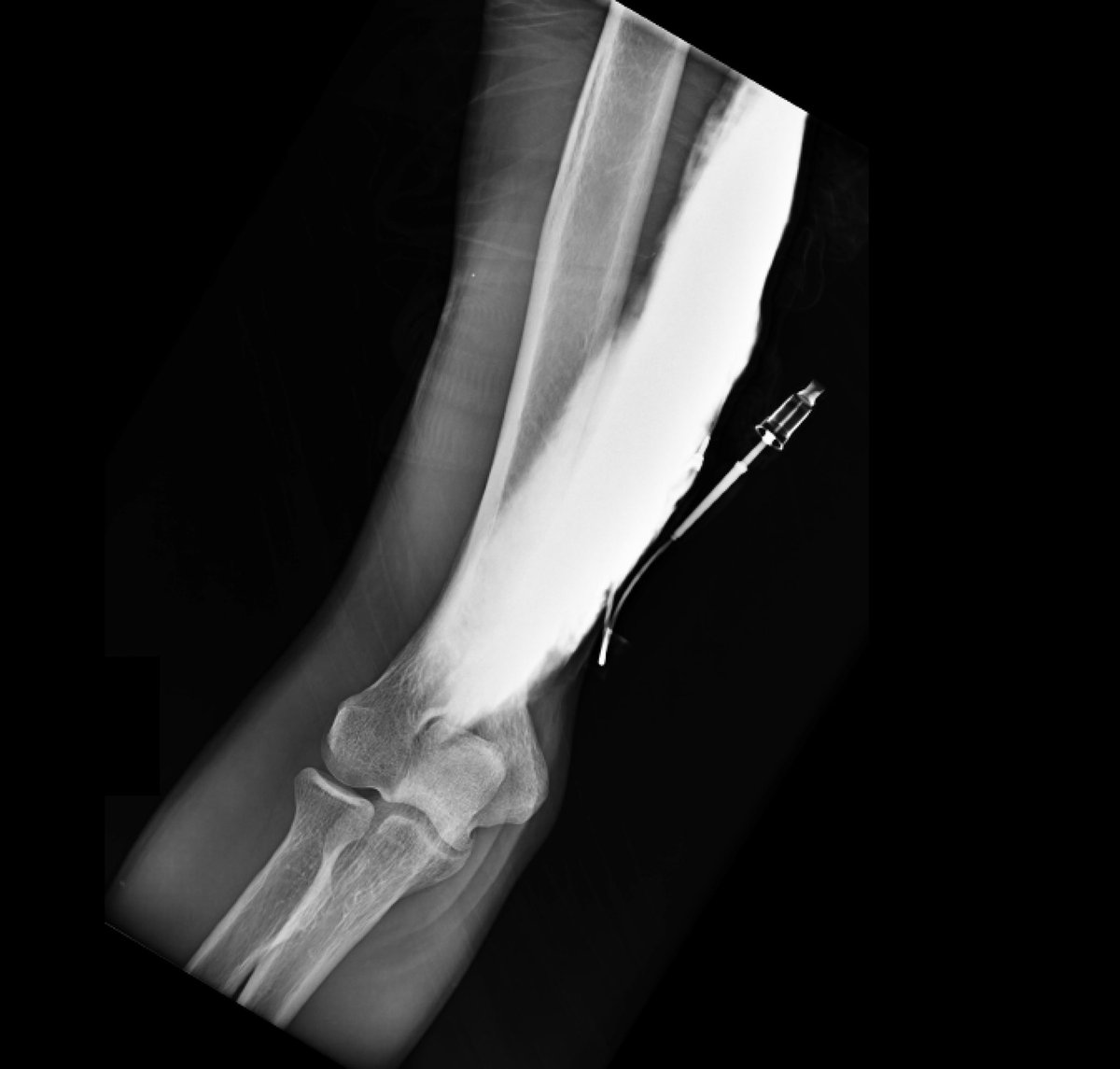 Sam Ghali, M.D. on Twitter "Here’s the XRay of a young man who