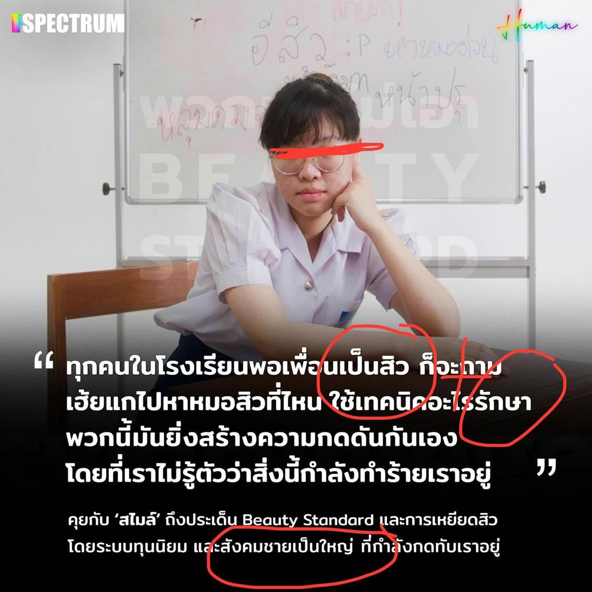 beamariyatach's tweet photo. นี่มันอะไรเนี่ย กุงงมาก
สังคมชายเป็นใหญ่อะไร โยงกันยังไง
งงไปหมด

สิวมันคือธรรมชาติ ใช่ แต่มันไม่ใช่อวัยวะปกติของเรา และการเป็นสิวเป็นหนองอักเสบ ก็ติดเชื้อได้ง่าย

ไม่ต้องเรื่อง beauty privilege/standard อะไร ง่ายๆเลยคือ การมีสิวมันไม่ใช่สิ่งที่ desirable และคว��รักษา แค่นั้น https://t.co/QD3FWIIm6p