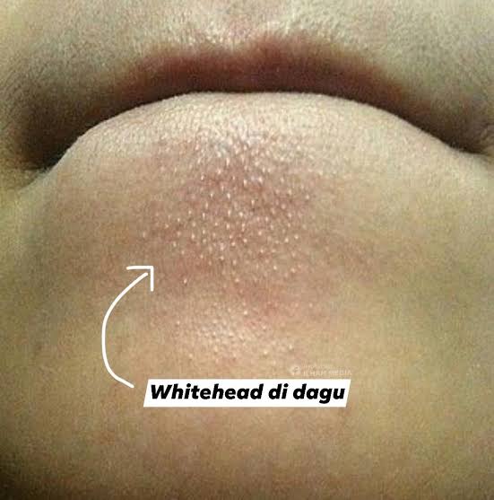 somexthings's tweet photo. Treatment blackhead &amp; whitehead!

- a thread - https://t.co/qV2RhHsVHs
