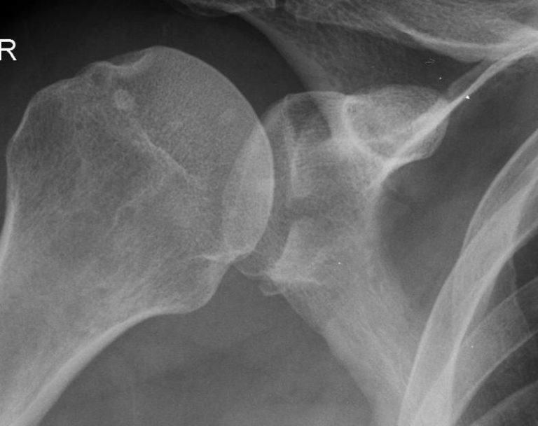 drchrisahmad's tweet photo. Question - What is a Bankart Lesion❓
It is an #injury of the anterior (inferior) glenoid #labrum of the #shoulder..
It is the most common injury associated w/ shoulder #dislocation..
More Info:
https://t.co/eVAG8LklXj☑️
#shoulderdoctor #shoulderinjury #orthopedics #thebest🥇 https://t.co/f1mQevOs7T