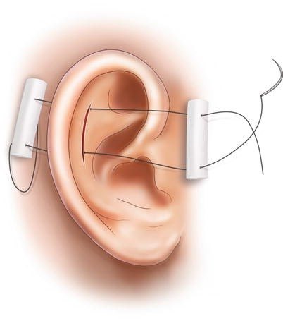 You may have heard (lol) that you should drain an auricular hematoma, but then what? Suturing down dental rolls to prevent🩸re-accumulation or placing some mattress sutures may ➡️ better outcomes and speedier return to sports than traditional compressive dressings #CincyAI