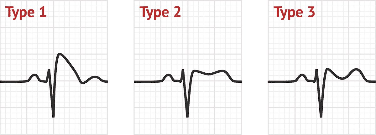 #CincyAI Brugada syndrome is a genetic disease affecting Na+ channels. Fever can elicit the classic EKG changes (below) and may also precipitate lethal ventricular arrhythmias. Make sure these pts have close cardiology follow up!