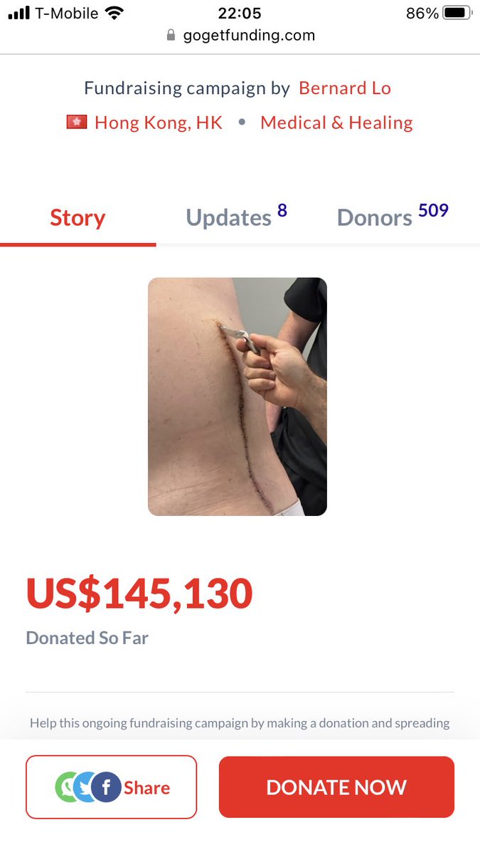 I’m stunned and humbled at the outpouring of compassion with the GoGetFunding campaign. 500+ donors helped cover surgery, and it’s working! Walking a mile a day now and many have reached out for my perspective on spine surgery and 7 years of previous failed operations. Blessings