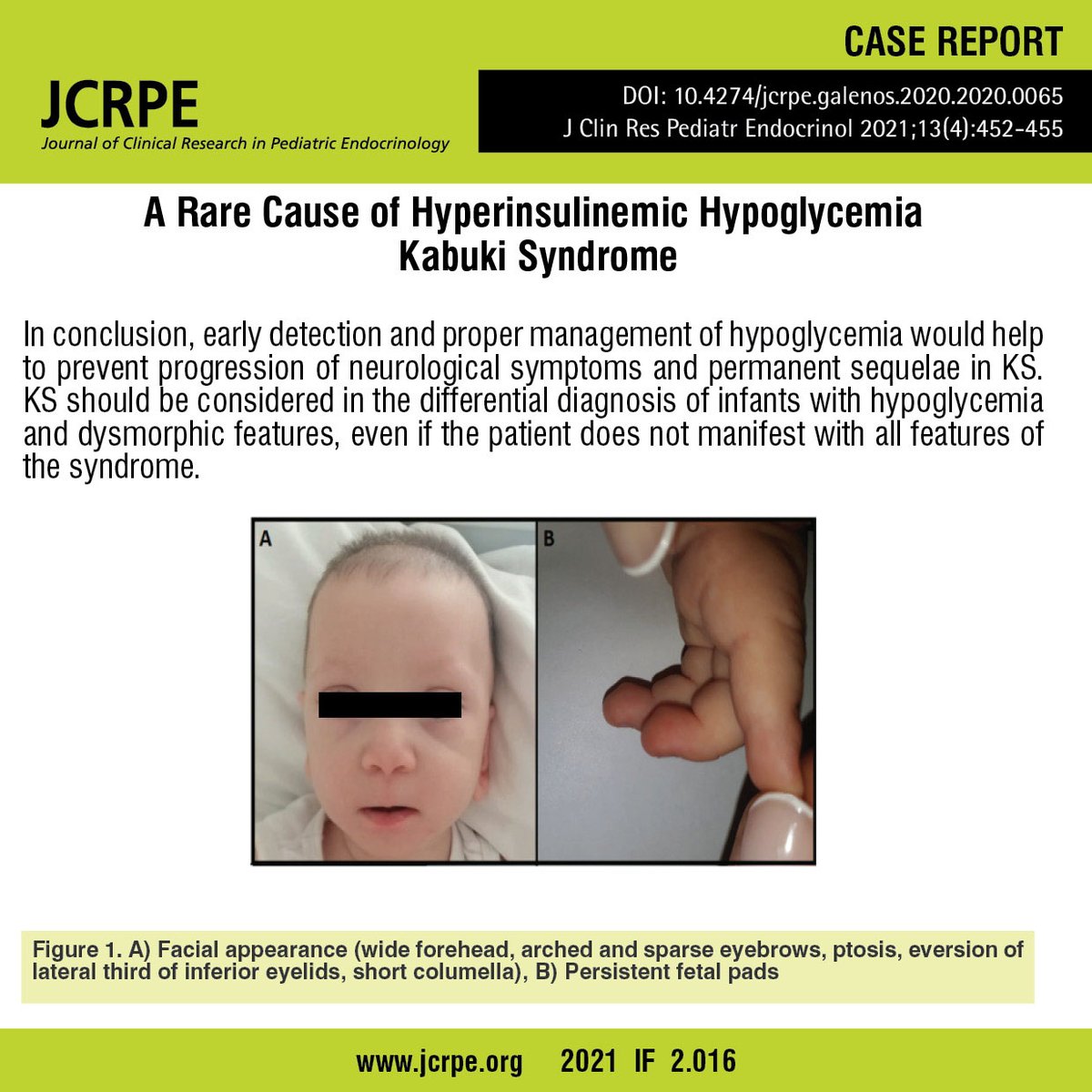 JcrpeOfficial's tweet photo. A Rare Cause of Hyperinsulinemic Hypoglycemia: Kabuki Syndrome by Mina Mısırlıgil et al.
Link : https://t.co/K48vr608jO
#Diazoxide #hyperinsulinemic #hypoglycemia #Kabukisyndrome https://t.co/HvmVsx1jVy