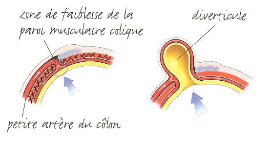 DrHepatoGastro's tweet photo. Une alimentation pauvre en fibre va produire des selles de petites tailles demandant au colon de fournir des contractions plus importantes pour les évacuer.
https://t.co/ZrwDGsZ45F https://t.co/DIC1mS5wrQ