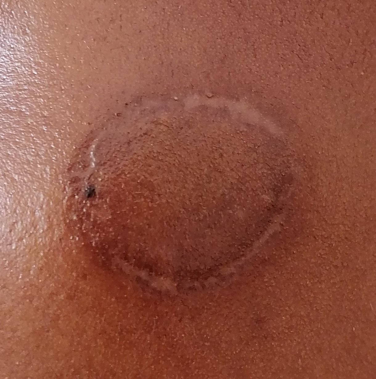 Mr_AsaP⚕️ on Twitter "MichaelBucwa What can I use to get rid of this