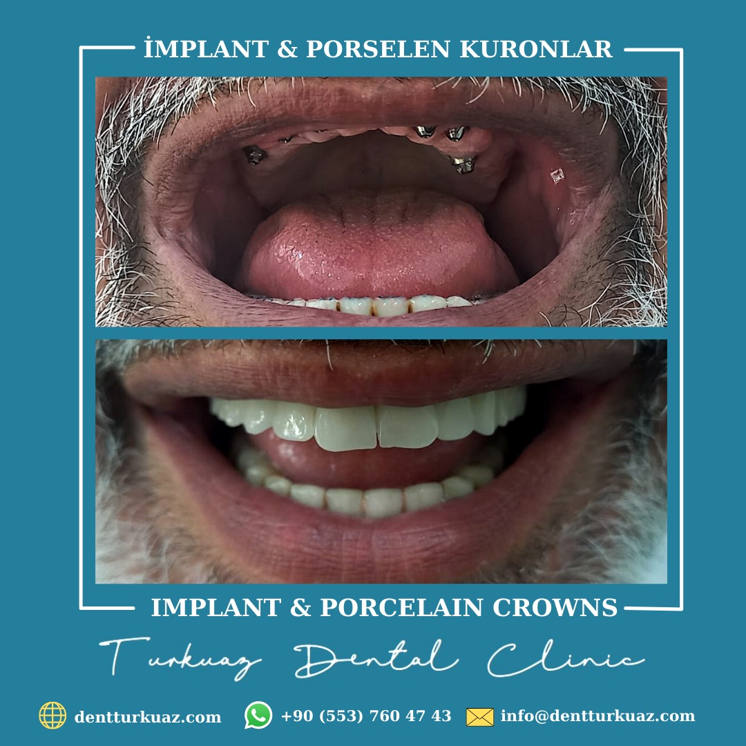 TurkuazDis's tweet photo. RANDEVU AL - HEKİME SOR
Online -Randevu: https://t.co/RJ7IICcM8Z
WhatsApp Randevu: +90 553 760 47 43
Turkuaz Ağız ve Diş Sağlığı Poliklinikleri

#implantustukuronlar #estetiktedaviler #dişetitedavisi #dent #turkuazdentalclinics #dentturkuaz #dtaysenaydinkurtul #dtihsanozal https://t.co/zHMU8yrozj