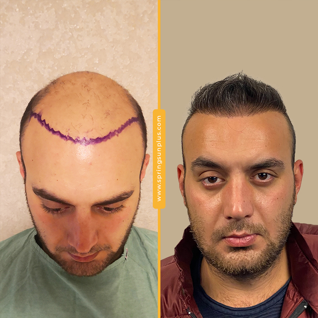 springsunplus's tweet photo. Hair transplantation operation in Turkey
#hairtransplantation #hairtransplantation #haartransplantation #trasplantecapilar #greffedecheveux #springsunplus #turkey #healthtourism https://t.co/yEz0q6eWSw