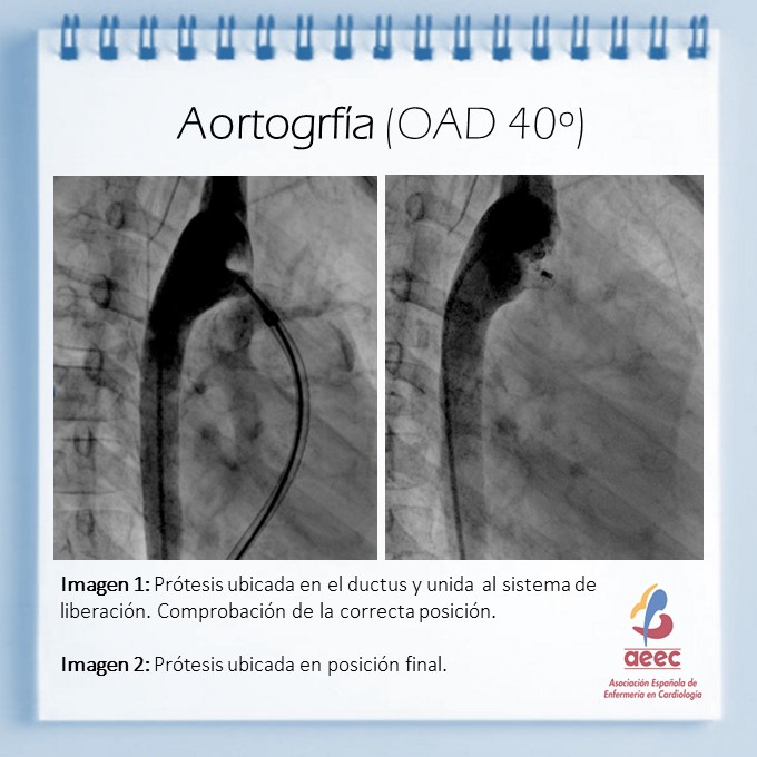 AEEC_enfcardio's tweet photo. Que es el DUCTUS ARTERIOSO PERSISTENTE y como se trata quirúrgicamente? #cardiologiapediatrica #nurselearning #campusaeec #ductusarterioso https://t.co/x2JtRl0WDz