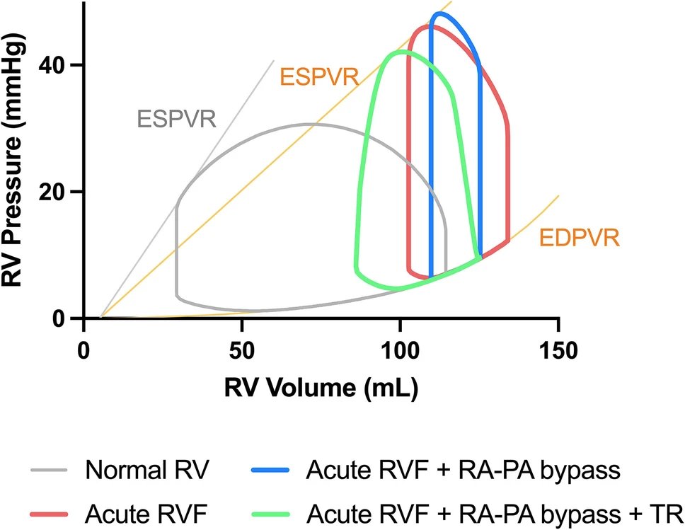 Congratulations to @ColumbiaCardio ⭐️fellow #FatimahAlkhunaizi on her 1st author review on the hemodynamics of RV MCS. Check out the sim 👇 showing impact of TR on RV MCS. If we're going to use these devices, gotta understand the physiology... #PCRtricuspid #PVLoops