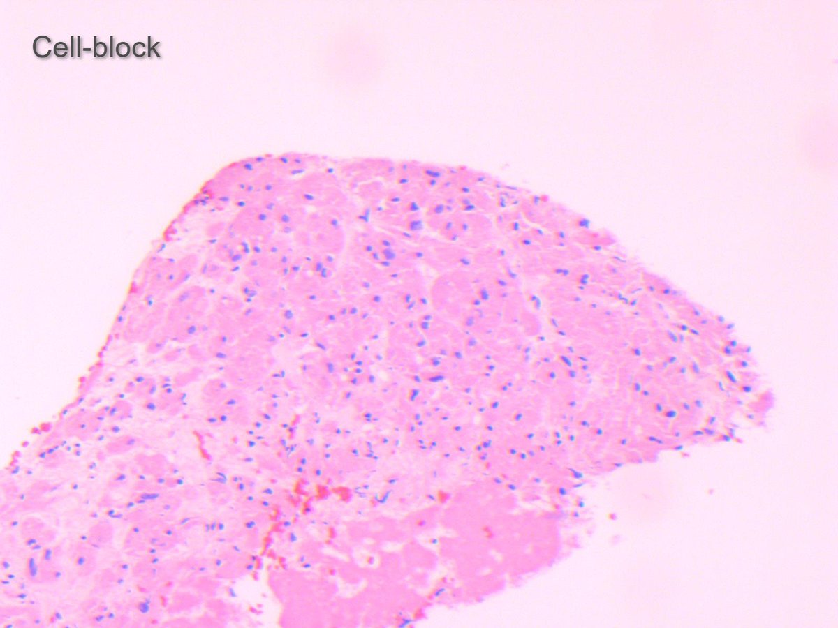 Miryousufkhan3's tweet photo. FNA of submucosal GE junction nodule (2X2 cm). Board style question: derived from what cell type? #cytopath #pathology https://t.co/Xxpn3rNwiJ