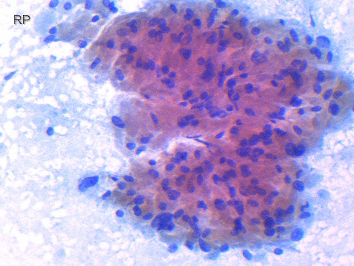 Miryousufkhan3's tweet photo. FNA of submucosal GE junction nodule (2X2 cm). Board style question: derived from what cell type? #cytopath #pathology https://t.co/Xxpn3rNwiJ