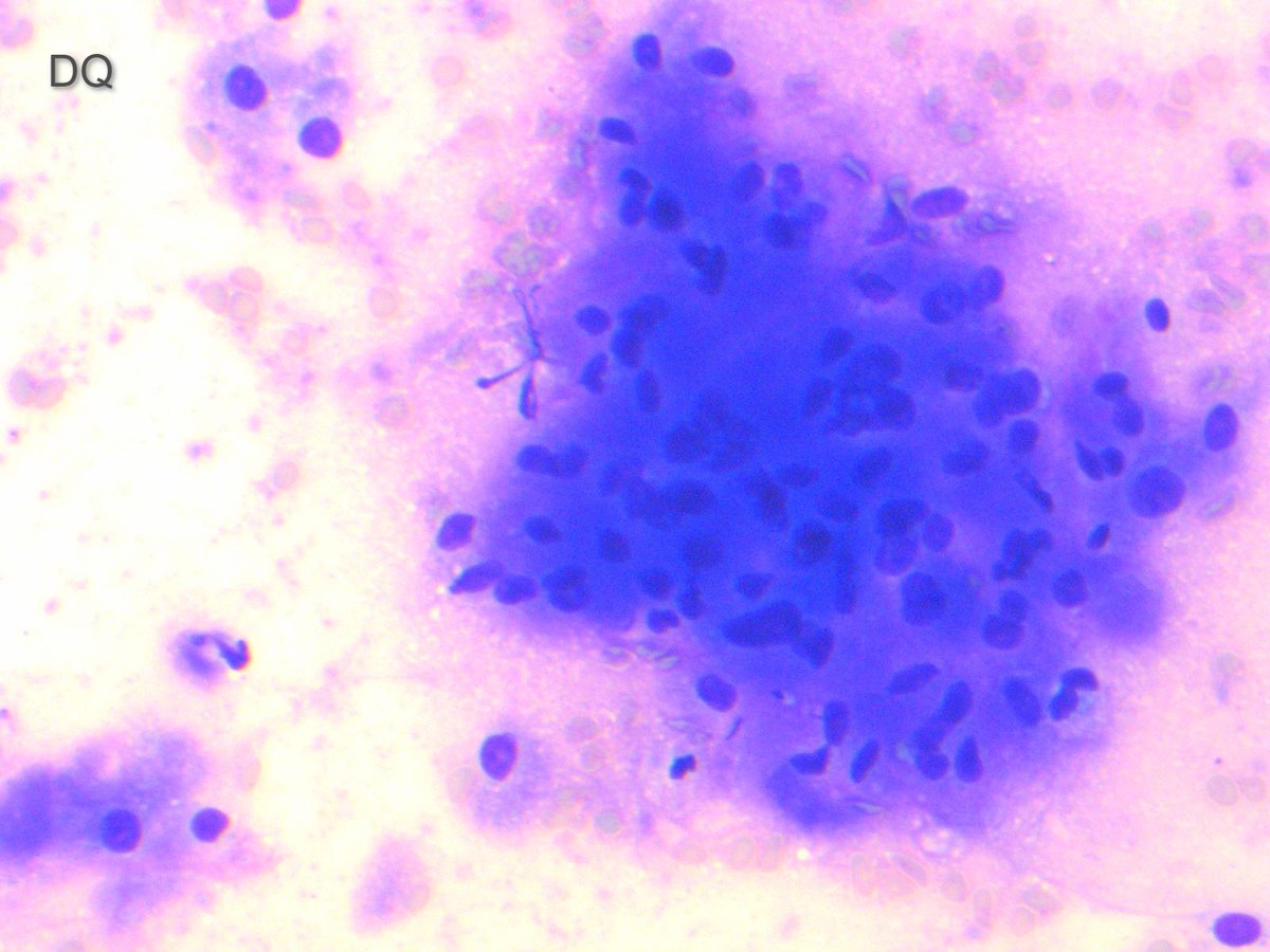 Miryousufkhan3's tweet photo. FNA of submucosal GE junction nodule (2X2 cm). Board style question: derived from what cell type? #cytopath #pathology https://t.co/Xxpn3rNwiJ