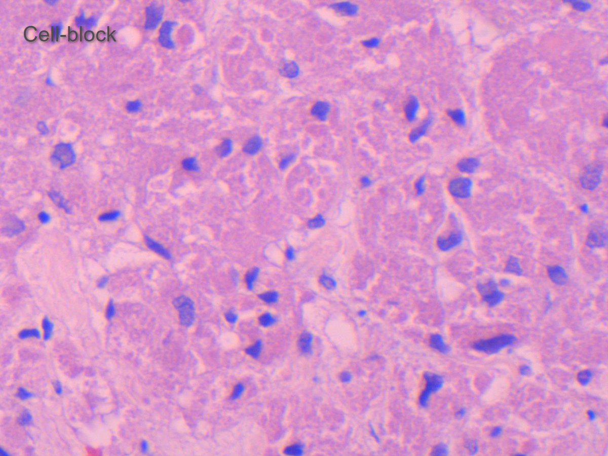 Miryousufkhan3's tweet photo. FNA of submucosal GE junction nodule (2X2 cm). Board style question: derived from what cell type? #cytopath #pathology https://t.co/Xxpn3rNwiJ