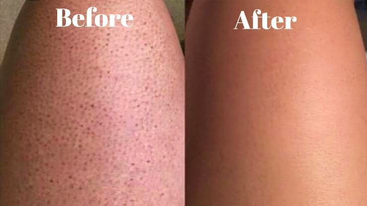 Strawberry legs — Boleh terjadi disebabkan selalu sangat shaving. 

Please AVOID shave kalau taknak jadi macamni 😩