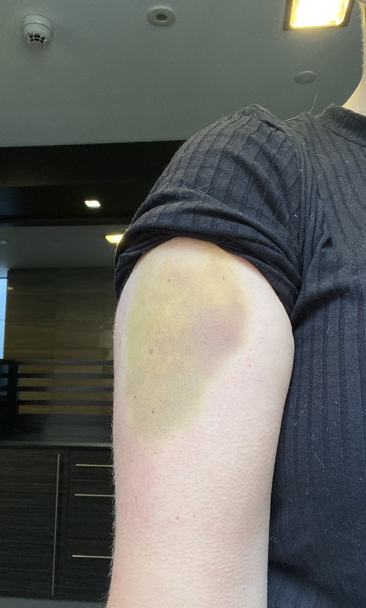 weevic18's tweet photo. Almost a pastel hue to the Big Bruise now. #ouch #bikefall https://t.co/bvjl1lYdT2