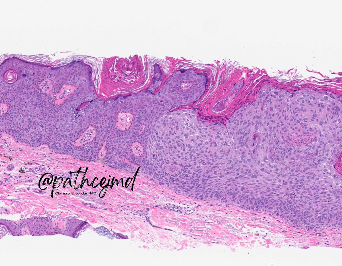 👋🏼 Just a quick #DermPath case on this lovely Wednesday: the photos below show a collision of what two entities? 💥

(Answer ⬇️)