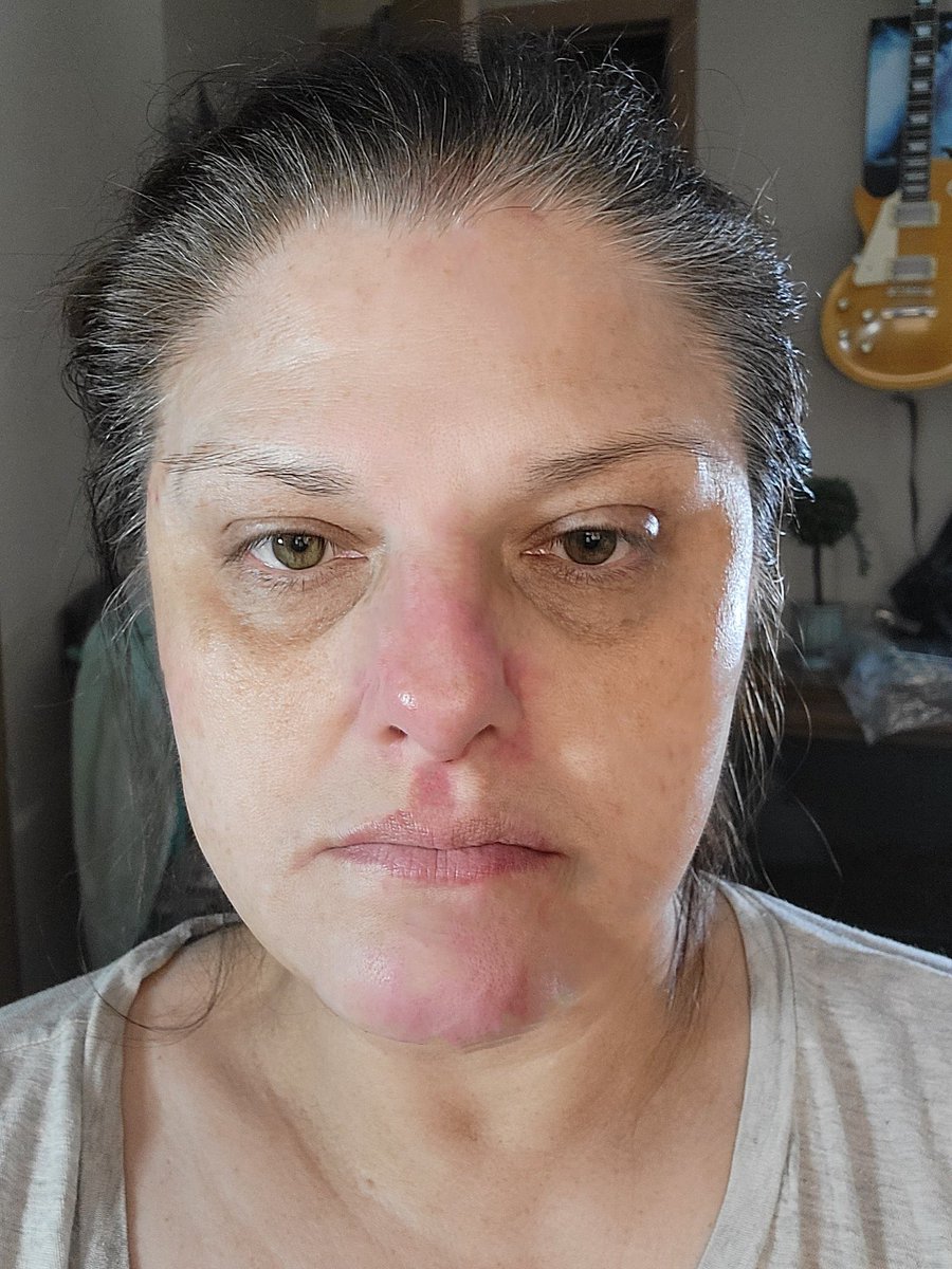 Dominicano809's tweet photo. @catparkerphoto @React19org @ChildrensHD @VaccineInjury @ReportAnInjury @VaccineReaction @VaccineInjuryUK @drbeen_medical @DrJamesOlsson @firuzimehta @DrSyedHaider2 https://t.co/pbqhe4DsxU