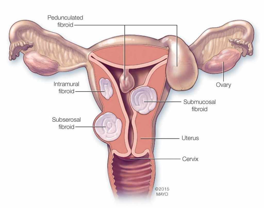 Can uterine #fibroids affect pregnancy? Depending on their size or location, they may affect a person's ability to get pregnant, stay pregnant or have a healthy pregnancy. bit.ly/3PPyTEB