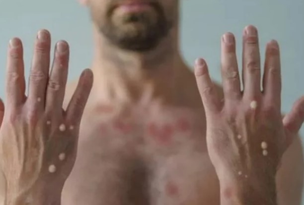 #Monkeypox: saiba qual o risco de pegar doença em situações cotidianas

Durante o período de infecção ativa, situações em que haja contato próximo podem levar à transmissão do vírus

Leia: cutt.ly/4XHeb4W