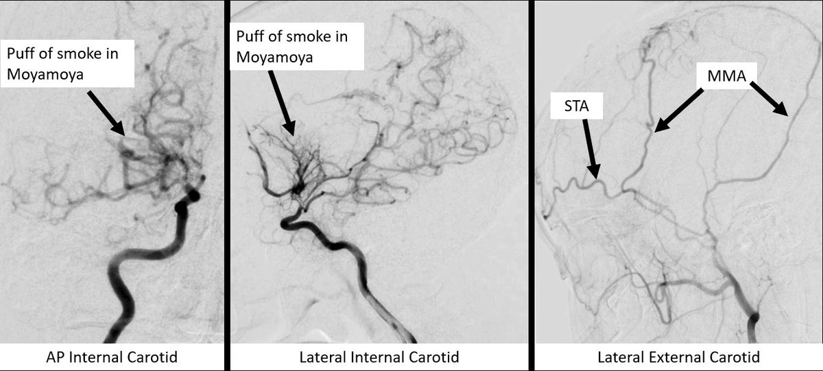 Jacques Morcos MD FRCS FAANS tweet media