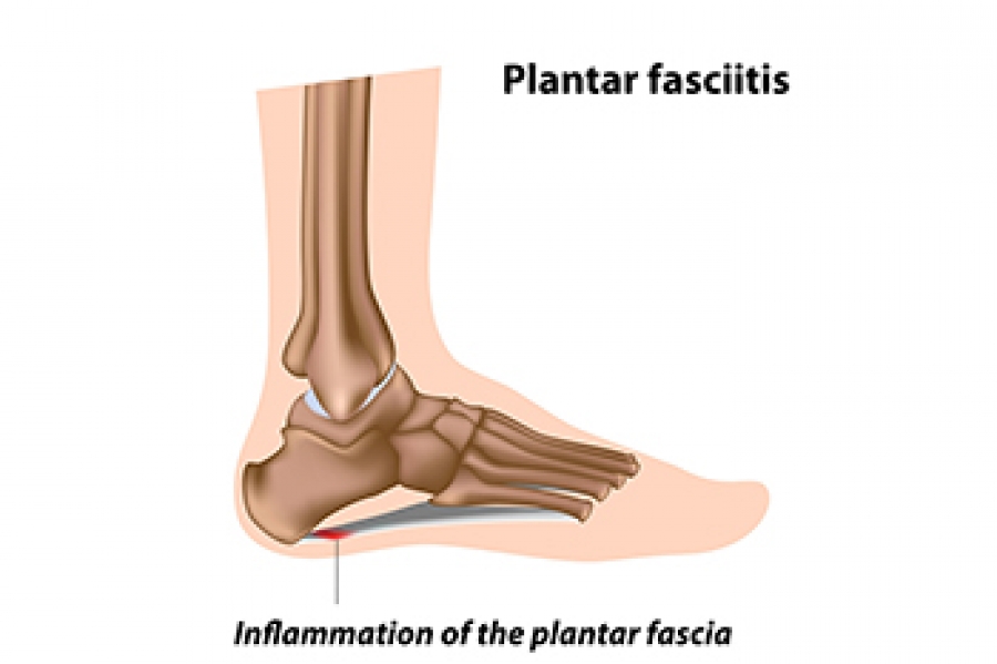 InStrideFoot's tweet photo. Plantar Fasciitis in Cyclists https://t.co/YknWclM6HI https://t.co/lYv1bhvO08