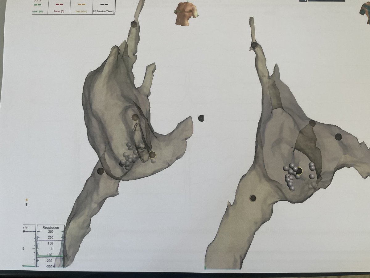 rfablation's tweet photo. First #Ensite #fluoroless #RFablation of #atrialflutter performed by only one electrophysiologist and one specialized nurse following #AbbottEnsiteMastershipCourse. No engineer. Nice final result. #Cardiotwitter #Epeeps Thanks to Michele Volonghi @messapus https://t.co/KSYEC8z8hS
