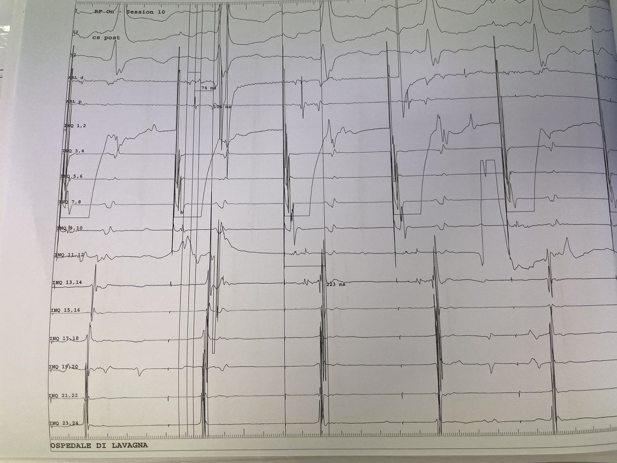 rfablation's tweet photo. First #Ensite #fluoroless #RFablation of #atrialflutter performed by only one electrophysiologist and one specialized nurse following #AbbottEnsiteMastershipCourse. No engineer. Nice final result. #Cardiotwitter #Epeeps Thanks to Michele Volonghi @messapus https://t.co/KSYEC8z8hS