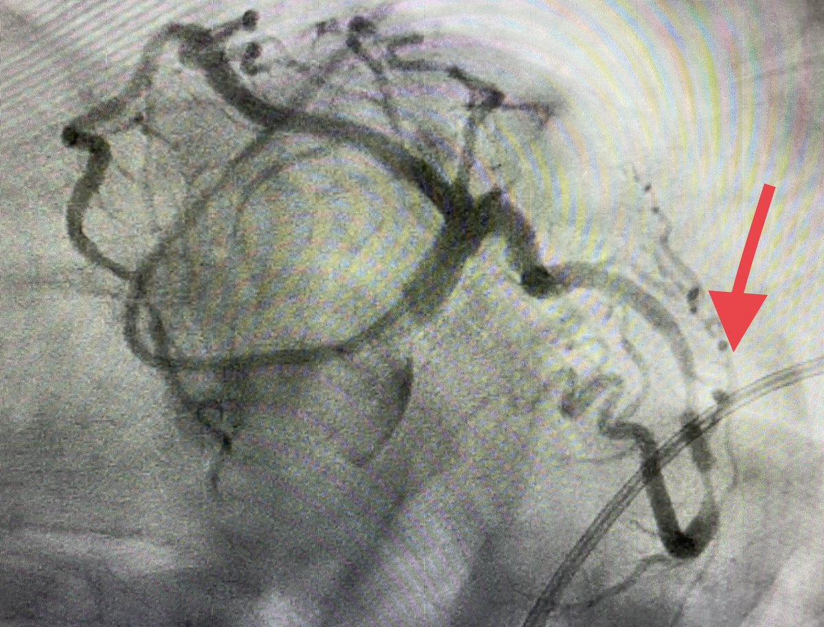 BURZOTTA_F's tweet photo. Happy to share: first ONYX FRONTIER #DES implanted in Europe 🇪🇺. Subocclusive lesion of angulated LCX causing #NSTEMI in a high #bleeding risk pt. Smooth #radialfirst #PCI. 
Time to thank all the people working daily with us in the cath lab under great direction of Carlo Trani ! https://t.co/q4CjlZfZQD