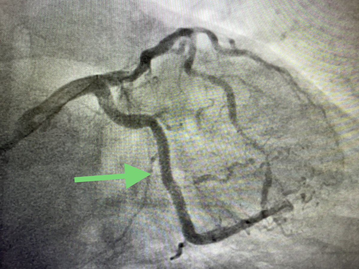 BURZOTTA_F's tweet photo. Happy to share: first ONYX FRONTIER #DES implanted in Europe 🇪🇺. Subocclusive lesion of angulated LCX causing #NSTEMI in a high #bleeding risk pt. Smooth #radialfirst #PCI. 
Time to thank all the people working daily with us in the cath lab under great direction of Carlo Trani ! https://t.co/q4CjlZfZQD