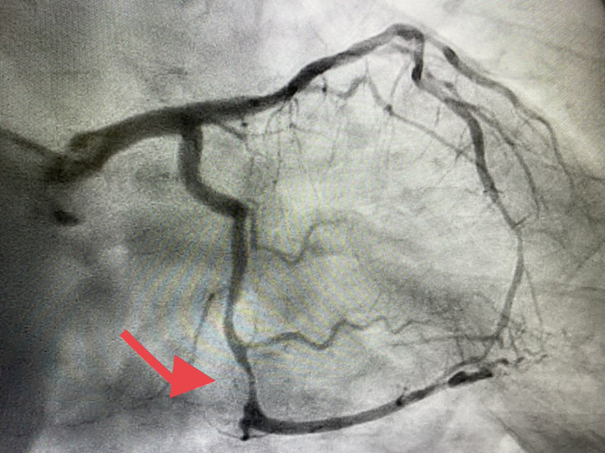 BURZOTTA_F's tweet photo. Happy to share: first ONYX FRONTIER #DES implanted in Europe 🇪🇺. Subocclusive lesion of angulated LCX causing #NSTEMI in a high #bleeding risk pt. Smooth #radialfirst #PCI. 
Time to thank all the people working daily with us in the cath lab under great direction of Carlo Trani ! https://t.co/q4CjlZfZQD