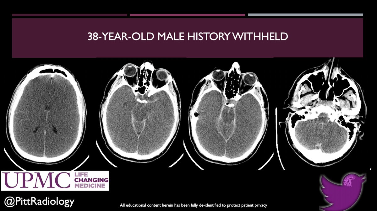 Katie S. Traylor MS, DO, DABR (@katietraylordo) on Twitter photo UPMC Case #99. Thanks Joshua Powell for this great do not miss case! Remember NO SPOILERS! <a href="/JudyGadde/">Judy Gadde, DO, MBA</a> <a href="/VikasAgarwalMD/">Vikas Agarwal</a> <a href="/JonEwald1/">Jon Ewald</a> <a href="/LaurenGrayDO/">Lauren Gray</a> <a href="/madeline_leo/">Madeline Leo</a> <a href="/DrPepperMD6/">Sarah Pepley</a> <a href="/SydneyNRubin/">Sydney Cooper (Rubin)</a> @EvaChau13 <a href="/MEMGRAD/">mgumus</a> <a href="/SurajParikhMD/">Suraj Parikh, MD</a> <a href="/ChristineDoepk2/">Christine Doepker, MD</a> <a href="/m_nicoleau/">Marvin Nicoleau, MD</a> <a href="/DavidHastie12/">David Hastie</a> UPMC Case #99. Thanks Joshua Powell for this great do not miss case! Remember NO SPOILERS! <a href="/JudyGadde/">Judy Gadde, DO, MBA</a> <a href="/VikasAgarwalMD/">Vikas Agarwal</a> <a href="/JonEwald1/">Jon Ewald</a> <a href="/LaurenGrayDO/">Lauren Gray</a> <a href="/madeline_leo/">Madeline Leo</a> <a href="/DrPepperMD6/">Sarah Pepley</a> <a href="/SydneyNRubin/">Sydney Cooper (Rubin)</a> @EvaChau13 <a href="/MEMGRAD/">mgumus</a> <a href="/SurajParikhMD/">Suraj Parikh, MD</a> <a href="/ChristineDoepk2/">Christine Doepker, MD</a> <a href="/m_nicoleau/">Marvin Nicoleau, MD</a> <a href="/DavidHastie12/">David Hastie</a>
