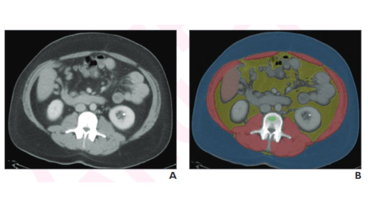 New <a href="/AJR_Radiology/">AJR</a> Accepted Manuscript:

"Utility of Fully Automated Body Composition Measures on Pretreatment Abdominal CT for Predicting Survival in Patients With Colorectal Cancer"

By Drs Lee, Pickhardt, &amp; team <a href="/UWiscRadiology/">UW Radiology</a> 

ajronline.org/doi/abs/10.221…