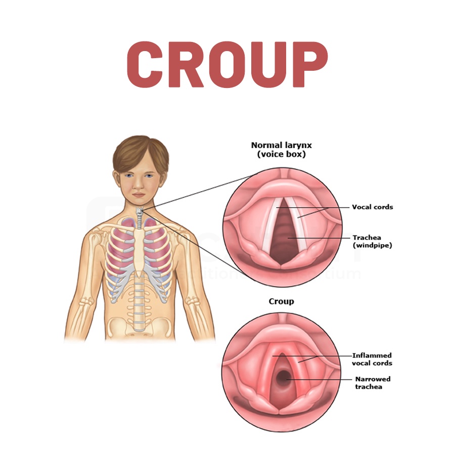 Docsteth1's tweet photo. Croup often runs its course within 3 to 4 day
To know more about CROUP click on the link
🔗https://t.co/QXh4W3Q3Sl
#Croup #cough #Respiratory Disorders #inflammation #allergia #Acupressure #laryngotracheitis #Docsteth #DocstethPost #MedTwitter https://t.co/JUfiBoIgLV