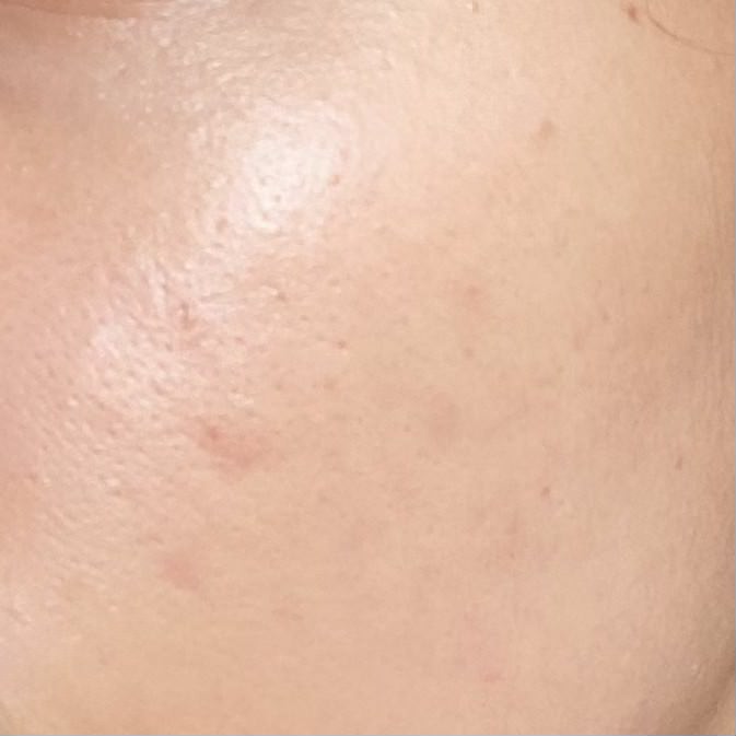 Ajaib banget serum brand lokal yang satu ini bikin jerawat sekaligus bekasnya hempas kayak gini😭❤️

From this                                     To this