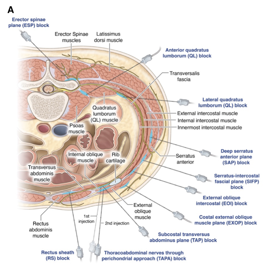 jon_bailey_anes's tweet photo. Fascial plane blocks: moving from the expansionist to the reductionist era
@CJA_Journal @Ropivacaine

"we run the risk of simply adding hay to the haystack, further obscuring any needles."

🔗 https://t.co/OJdciBMuTr

Thoughts?
@amit_pawa @jeffgadsden @KiJinnChin @LloydTurbitt https://t.co/TFXGJ3McCL