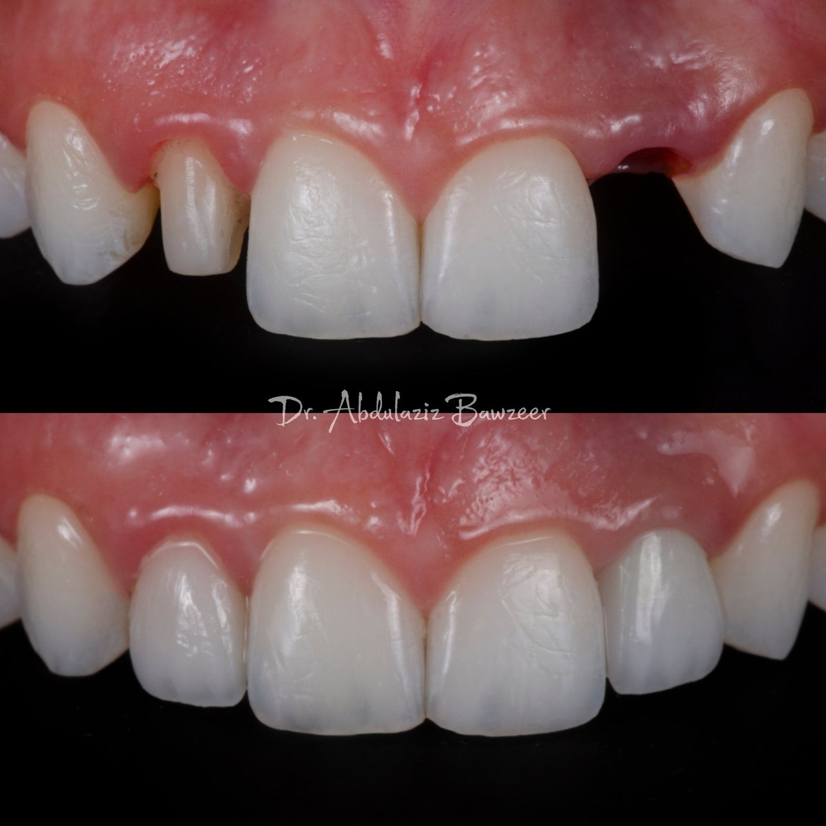 Aziz_Bawzeer's tweet photo. Anterior implant crown and single veneer on laterals
زراعة وعدسة واحدة فقط https://t.co/4Vmkvih7zn